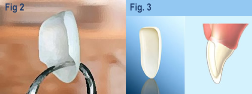 fig-2-faccetta