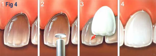 fig-4-faccette-estetiche
